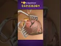 Download Lagu Appendix Surgery 3D Animation