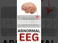 Download Lagu Abnormal EEG on a patient with seizures