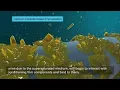 Tria Ureteral Stents - Calcium Oxalate