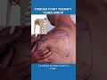 Releasing Teres Minor Trigger Points