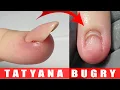 Download Lagu Nail TORN OFF Nail Bed 😱 | Correcting Nails Growing Upward