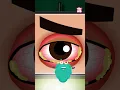 Download Lagu What Is Pink Eye? What Causes Conjunctivitis #shorts #pinkeye #conjunctivitis #drbinocsshow