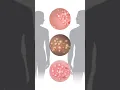 Download Lagu 3 Warning Signs of Genital Herpes