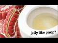 Why Do I Pass Jelly-Like Mucus from My Anus Causes Symptoms When to Seek Help