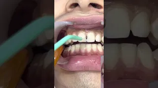 تجميل الأسنان الأمامية تنظيف تسوس الأسنان Etching For Composite Restoration 