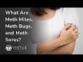 What Are Meth Mites Meth Bugs and Meth Sores