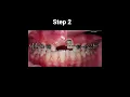 How do braces work