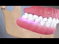 Flexible Partial Dentures Animation