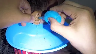 Flushing Out Boy's Ear to Remove STUCK Earwax