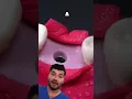 Download Lagu Dental Implant Explained !?
