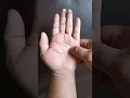 Download Lagu Cara Mengatasi Serangan Jantung atau Angina Pectoris (Jakarta Timur, Bekasi, Pondok Kopi)