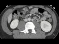 Duplicated inferior vena cava