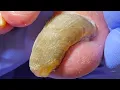 Download Lagu Cut The Snake Like Onychomycosis Step By Step!【Dr. Liu's Pedicur】
