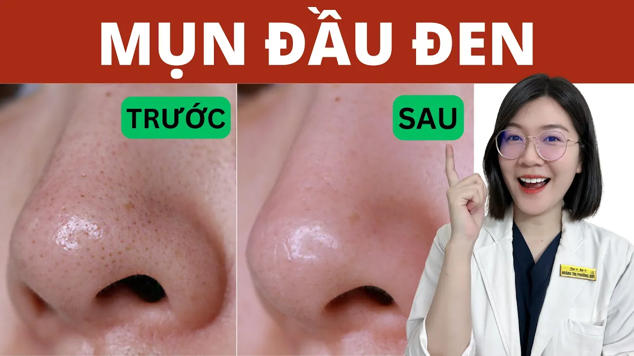 Outline Video Trị MỤN ĐẦU ĐEN - SỢI BÃ NHỜN hiệu quả sau 2 TUẦN | Thạc sĩ - Bác sĩ Phương Quý