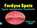 Fordyce Spots Symptoms Causes Treatment Fordyce Spots on lips Fordyce Granules