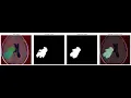 Segmenting Brain Tumor MRI Images UNet Deep Learning Semantic Segmentation Keras Python