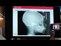 Overview of orthognathic surgery Diagnosis and treatment planning - Professor Dr Shahid R Aziz