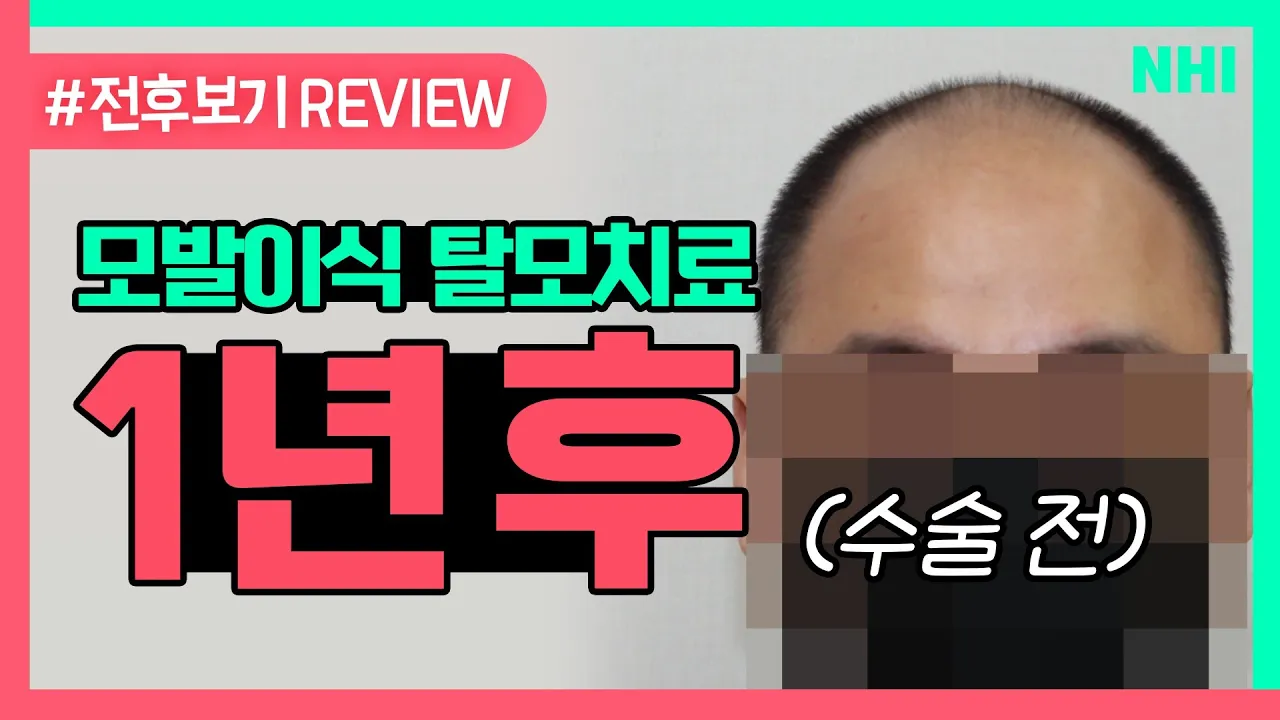 모발이식 1년 후 머리카락이 생겨버림ㅣ전후보기reviewㅣ뉴헤어