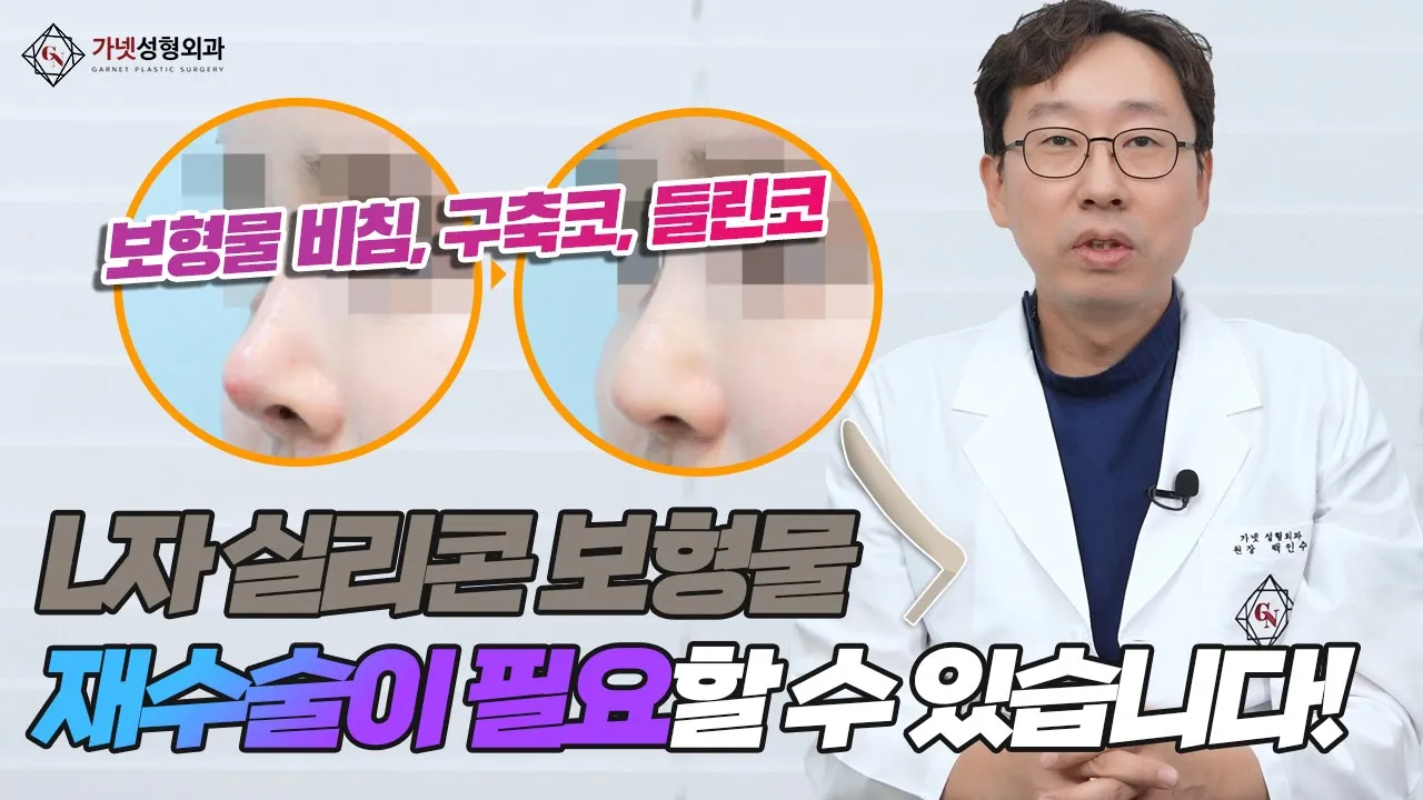 원장님! 코성형 보형물이 코를 뚫고 나올것 같아요😭 보형물 비침, 구축코, 들린코, L자실리콘 코재수술 방법 알려드립니다.