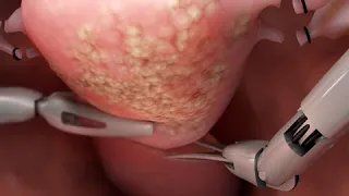 robotic hysterectomy