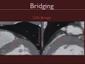 Coronary Artery Anomalies 1