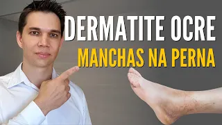 DERMATITE OCRE! Como clarear as manchas nas pernas?!