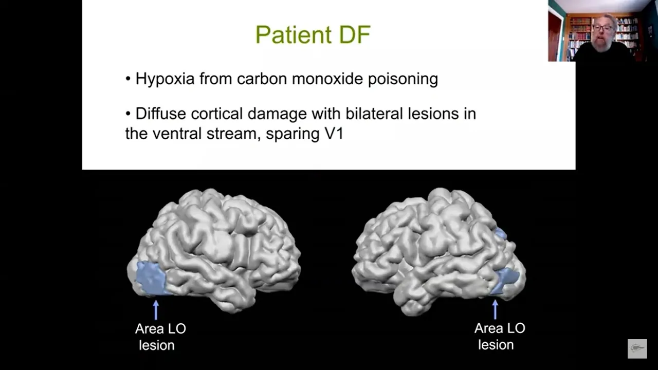 Mel Goodale: How DF and other single-cases have illuminated our understanding of the visual pathways