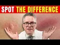 Lyme Disease vs Spider Bite How to Tell the Difference