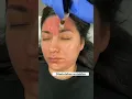 Download Lagu MICRONEEDLING BENEFITS