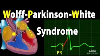 Wolff Parkinson White Syndrome Pathophysiology Pre Excitation And AVRT Animation 