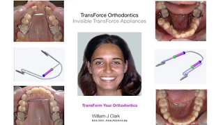 TransForce Orthodontics