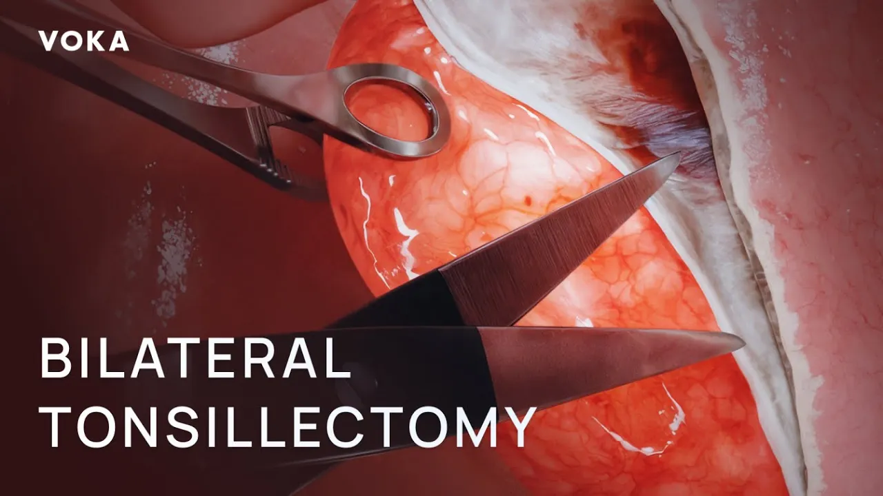 VOKA tonsillectomy 3D video