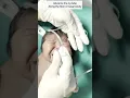 NG tube / feeding tube insertion in a newborn | pediatrics #newborn #shorts  #thebabydoctor
