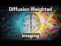 DWI MRI Scan Sounds Explained Diffusion Weighted Imaging for Multiple Sclerosis MS MRI Scan