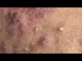 Acne Treament Under The Skin