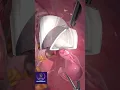 Download Lagu Laparoscopic Tissue Removal #shorts #medicalsurgery