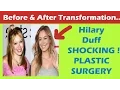 Hilary Duff Plastic Surgery Before and After