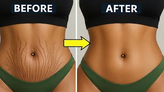 Stretch Marks🌿Remove in 9 Minutes🌴pregnancy stretch marks, gym stretch marks, permanent treatment