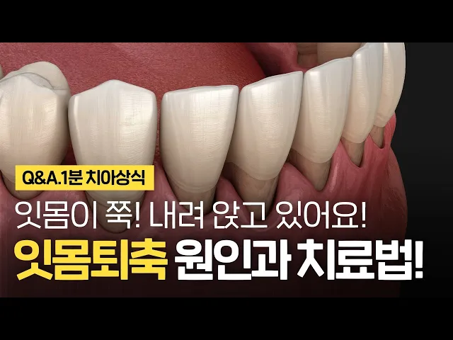 잇몸 내려앉음! 잇몸퇴축의 원인과 예방할 수 있는 방법은?