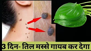 तिल और मस्से को 5 मिनट में जड़ से ख़त्म करने का सबसे अच्छा उपाय Remove Skin Tags