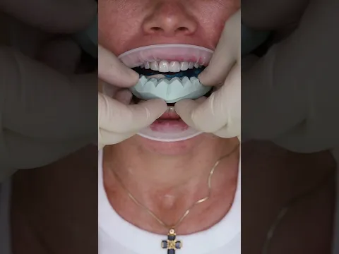 Wax up veneers #shorts #dentist #dental #implant #veneers #short