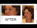 Testimonial Upper and Lower Eyelid Surgery with Laser Skin Resurfacing