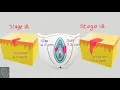 Download Lagu FIGO staging of vulvar cancer 2021