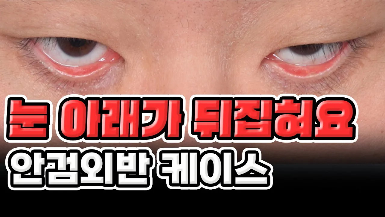 교통사고 당한 이후로 눈꺼풀이 뒤집혀요... │ 안검"내"반 수술 잘못받으면 큰일나요!!
