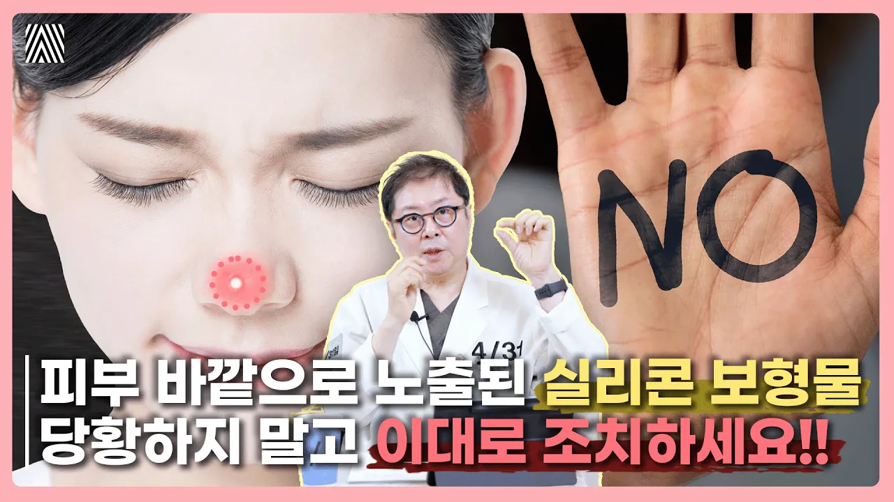 코 보형물이 노출되신 분들은 꼭 보세요! 전조 증상부터 치료 방법까지 안내해 드립니다! 코 보형물 노출 1편_[4월31일 성형외과]