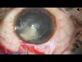 Download Lagu SICS in a posterior polar cataract - with Thinking process : Pradip Mohanta, 9th April, 2023