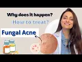 Fungal Acne Why does it happen How to treat Dermatologist Dr Aanchal Panth