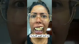 إيه لازمه تقويم الأسنان  إيه لازمه تقويم الأسنان