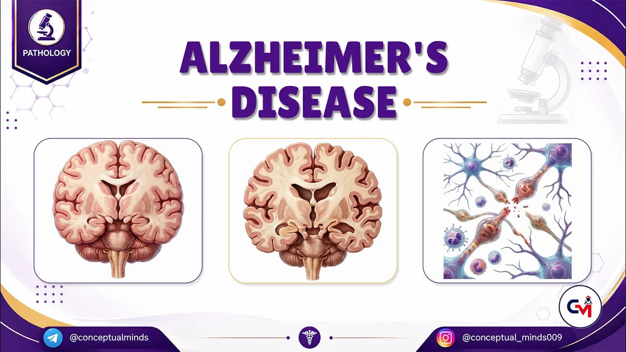 Alzheimer’s Disease 🧠 Pathology, Amyloid Plaques & Neurofibrillary Tangles | Neuropathology