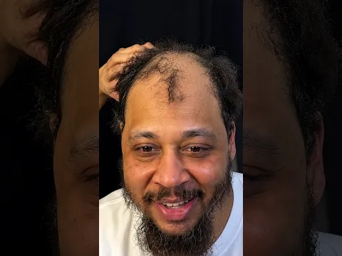 Can his hairline beat the ODDS?